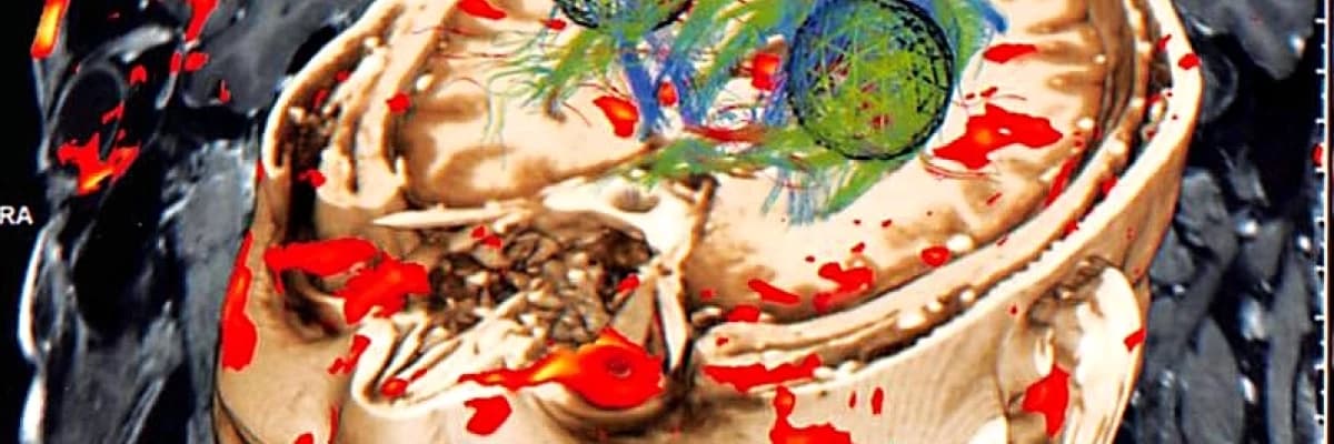 Tinnitusta ( kulak çınlaması -uğuldama) gelişmeler ve Realiteler