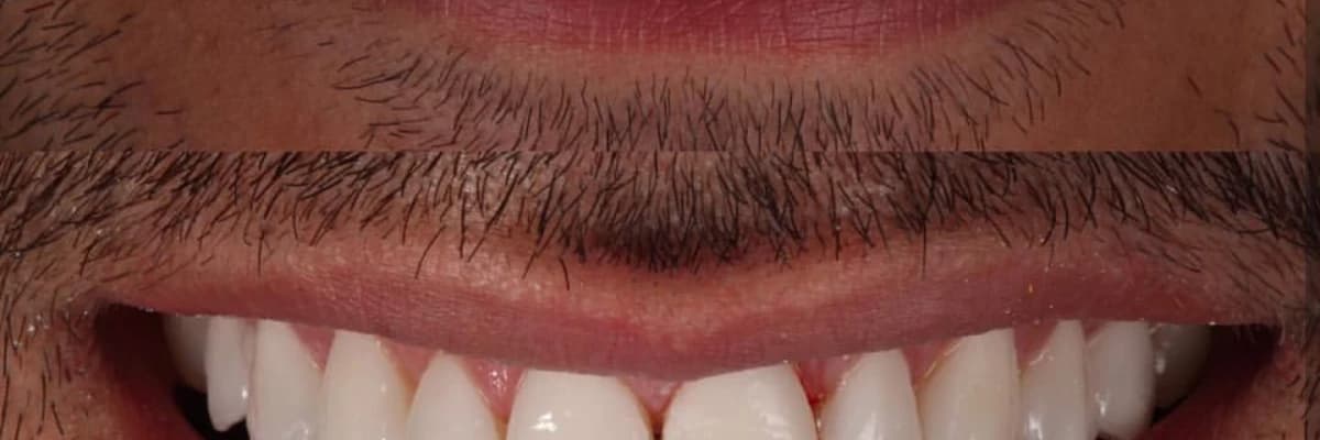 Zirkonyum diş nedir ? Gülüş estetiği nasıl sağlanır ?