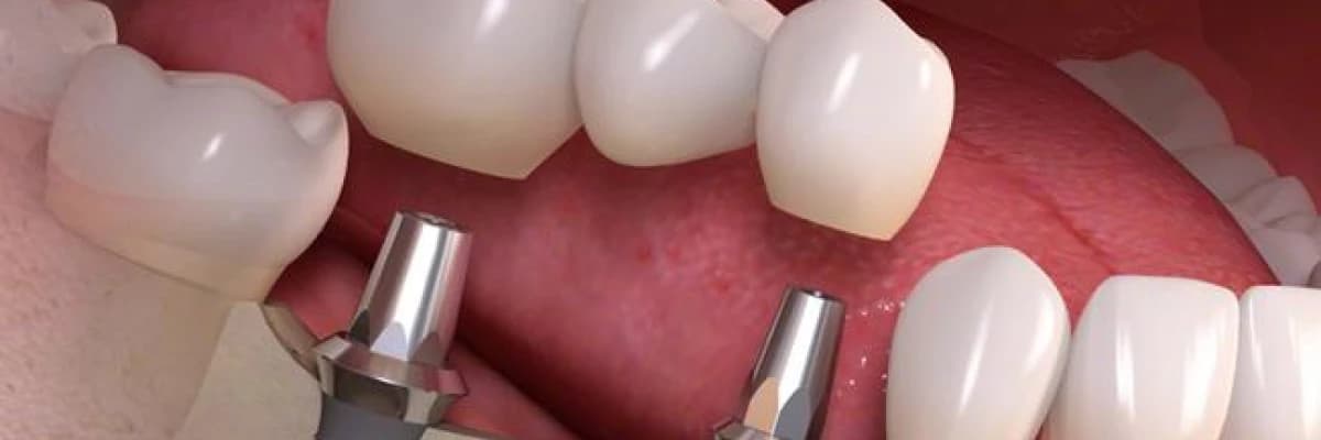 Dental İmplant Diş Tedavisinin Avantajları Nelerdir ?