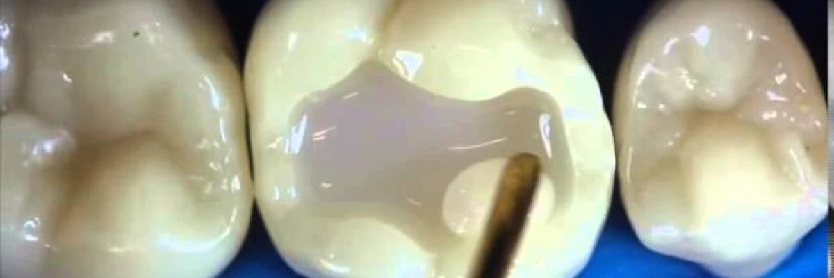 Diş Çürüklerinde Erken Tanının Önemi