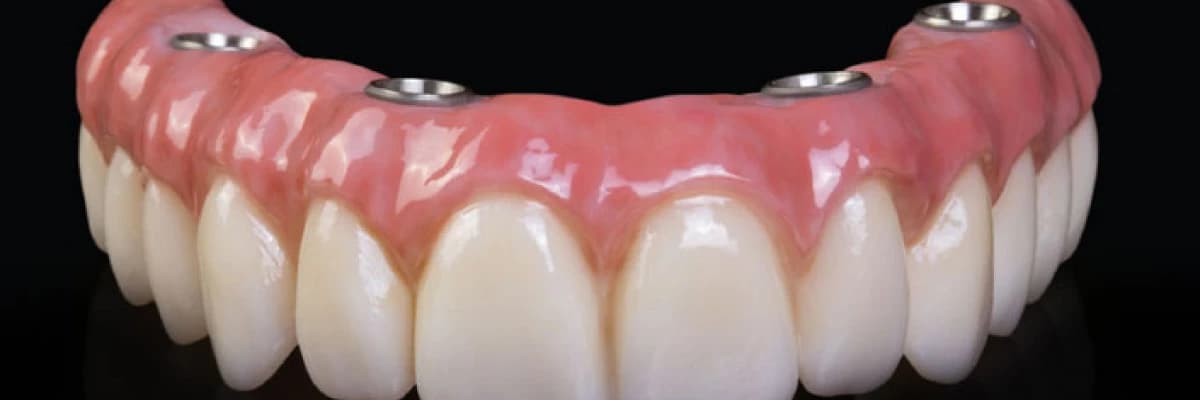 İmplant Kimlere Uygulanır Ve Kimlere Uygulanmaz ?