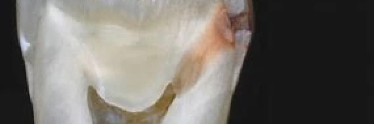 Kanal Tedavisi Nedeni