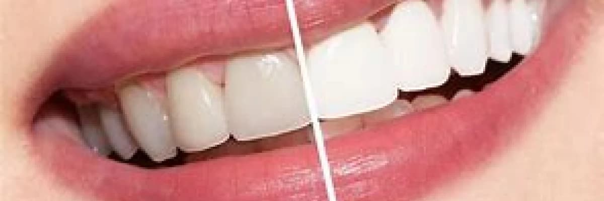 Diş Beyazlatma / Bleaching İşlemi