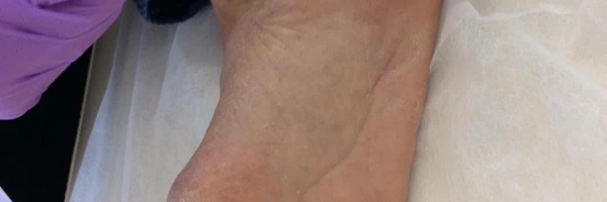 Topuk Dikeninde Yüz Güldüren Yeni Nesil Tedaviler