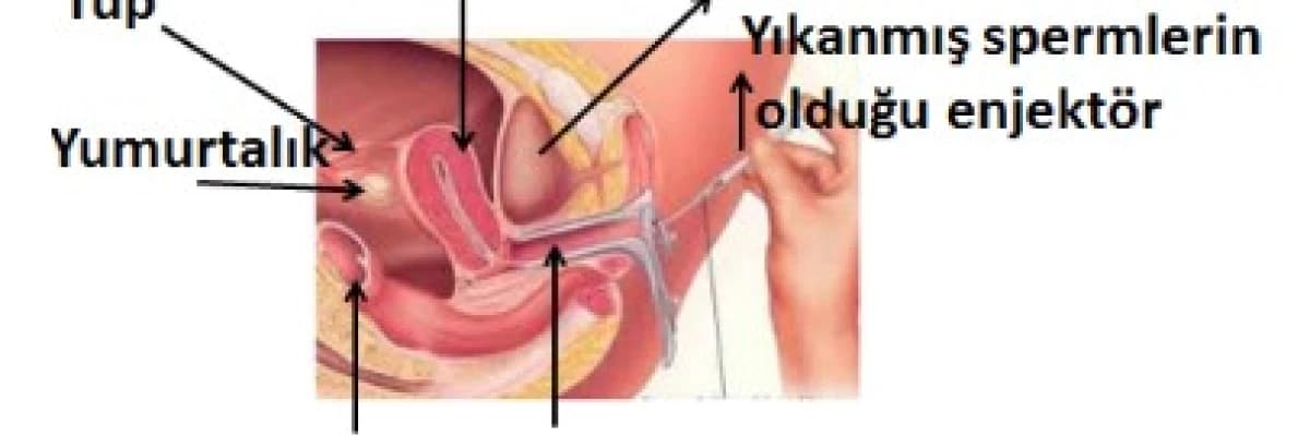 AŞILAMA (IUI - Intra Uterin Inseminasyon)