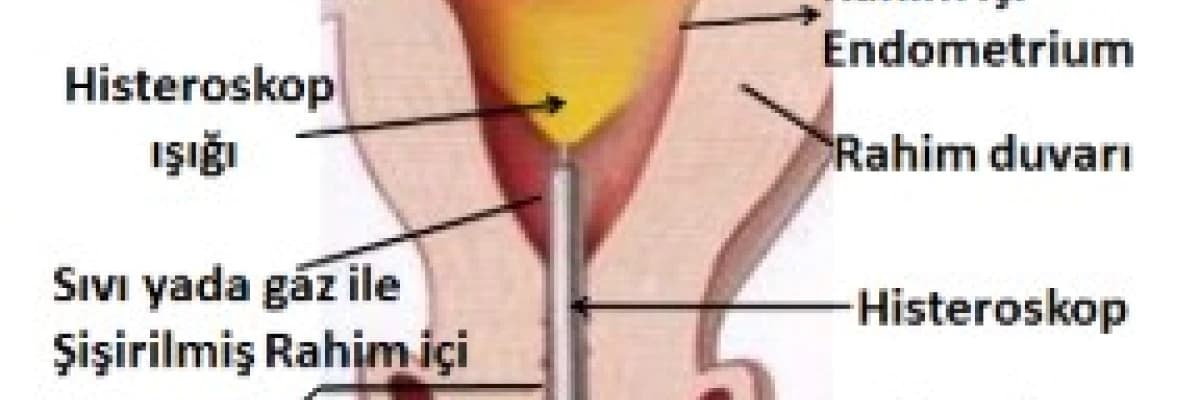 Histeroskopi nedir? Hangi konularda kullanabiliriz?