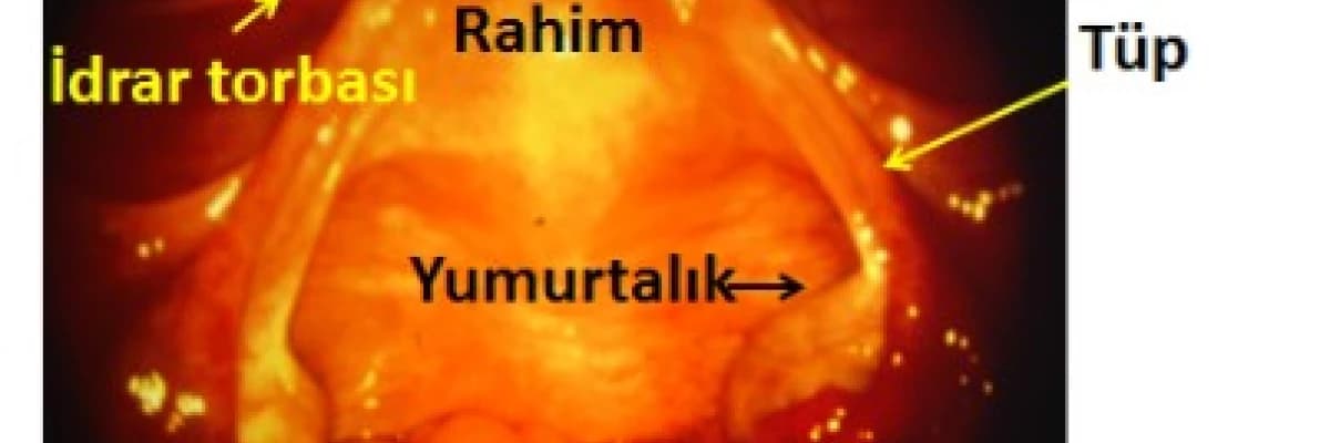 Laparoskopi nedir ? Hangi operasyonlar başarı ile yapılabilir?