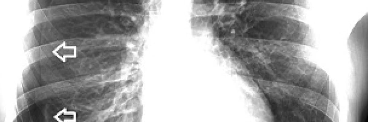 Pnömotoraks (akciğerde hava toplanması)