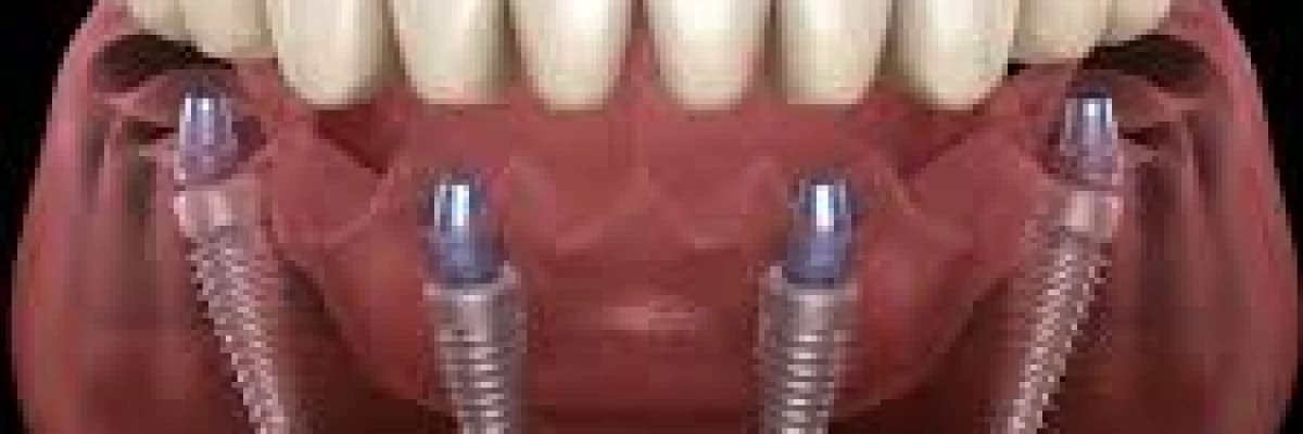 Implant hakkında bilmedikleriniz