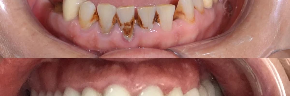 Zirkonyum uygulaması