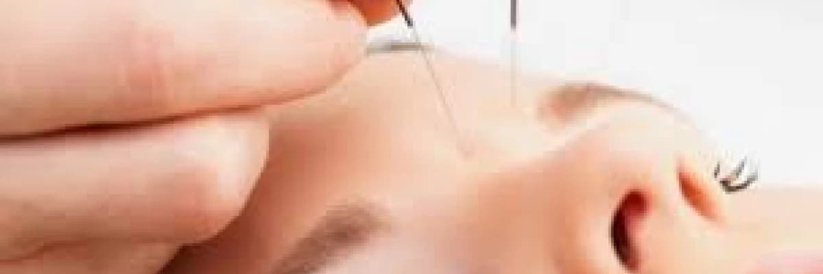 SAĞLIĞINIZ İÇİN DOĞAL YÖNTEMLERDEN; AKUPUNKTUR