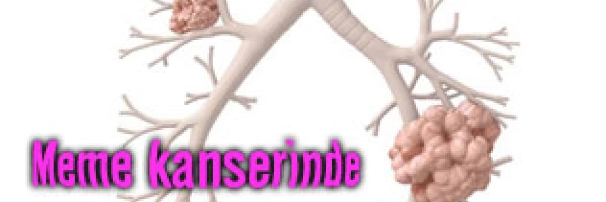 Meme kanserinde estetik çözüm