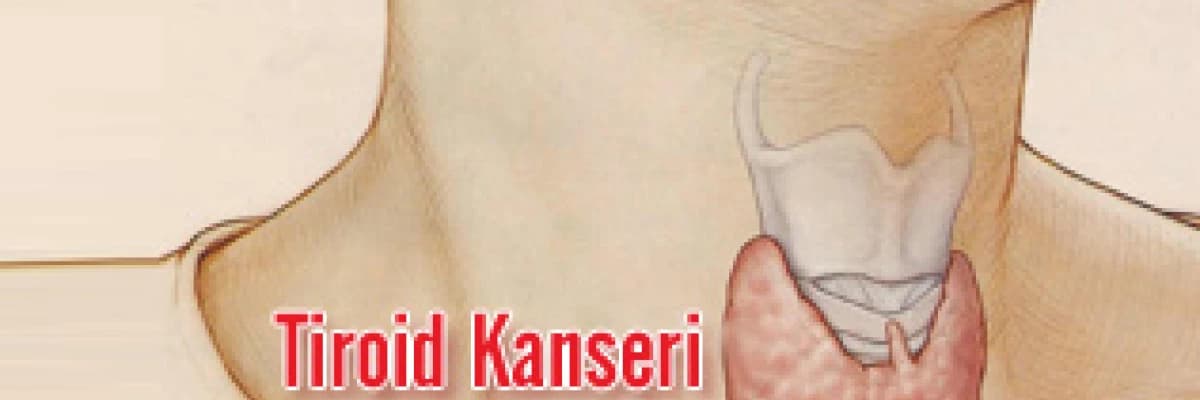 Tiroid kanseri