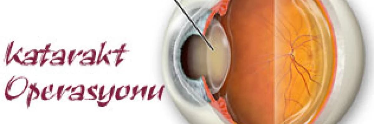 Katarakt operasyonu