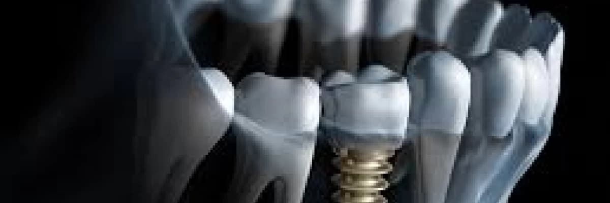 Diş implantları !