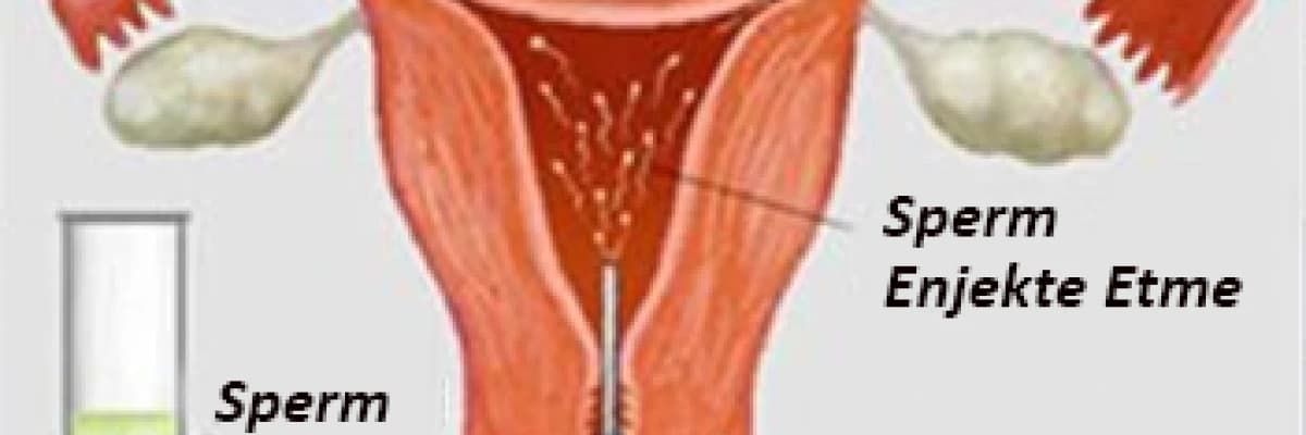 Aşılama ( İnrtauterin İnseminasyon ) Tedavisi Hangi Çiftlere Uygulanabilir ?
