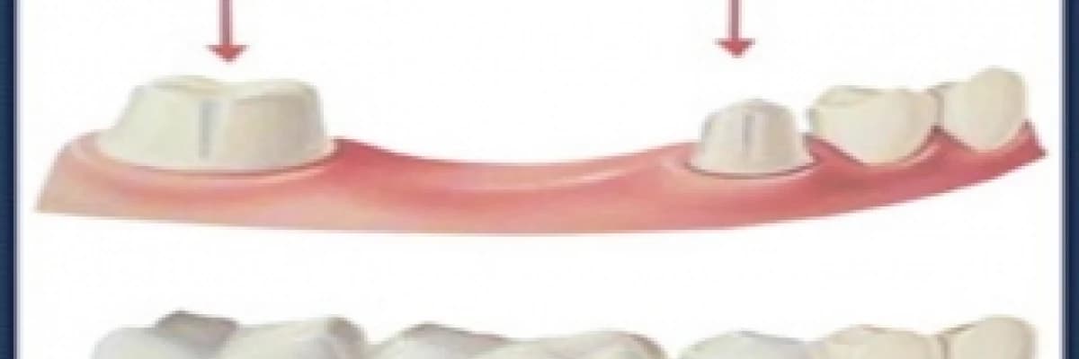 Kuron- köprü tedavileri