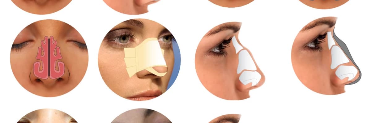 Burun estetiği için nefes almaktan vazgeçmeyin!