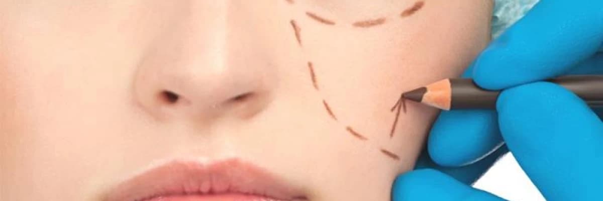 Göz Kapağı Estetiği ( Blepharoplasty )