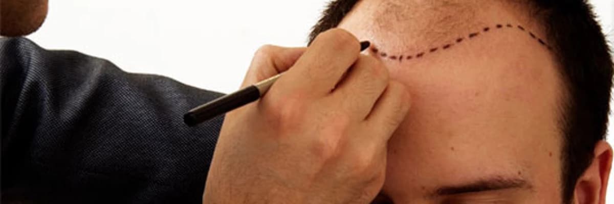 Follicular Unit Extraction - Fue Saç Ekiminde Alternatif Bir Yaklaşım