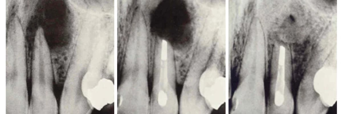 Apse ve Kist Operasyonları