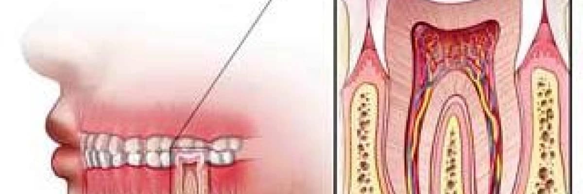 Kanal Tedavisi Ne Zaman Gereklidir ?