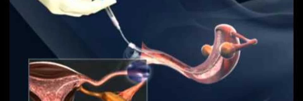 İntrauterin inseminasyon (aşılama tedavisi)