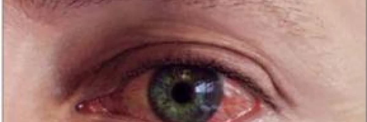 Alerjik konjunktivit (göz alerjisi)