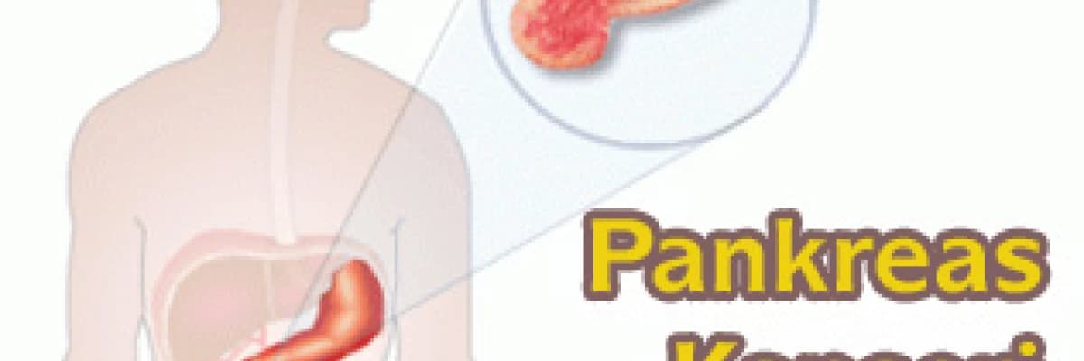 Pankreas kanseri
