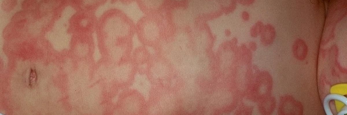 Kurdeşen (ürtiker) / anjiyoödem