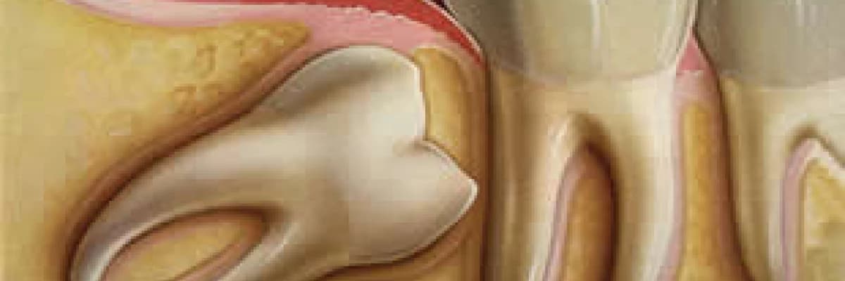 20 Yaş Dişleri ve Olası Tehlikeleri