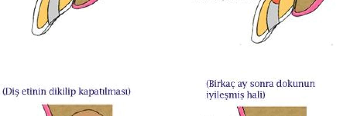 Çekim Kararı Alınan Diş Kurtarılabilir mi ?