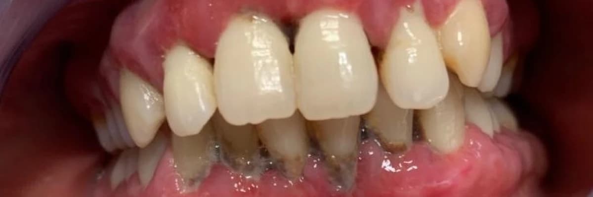 Dişeti hastalığı- periodontitis