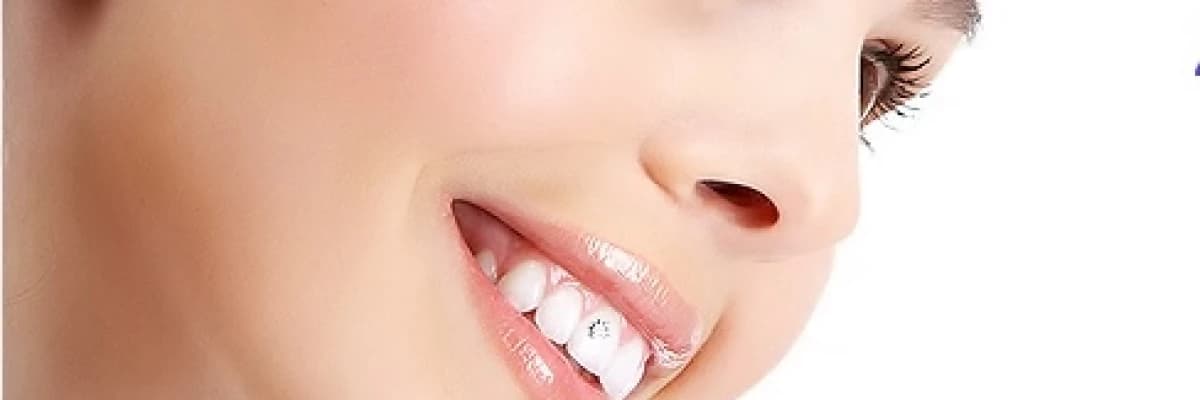 Laminate veneerler lamina diş ile estetik gülüş.