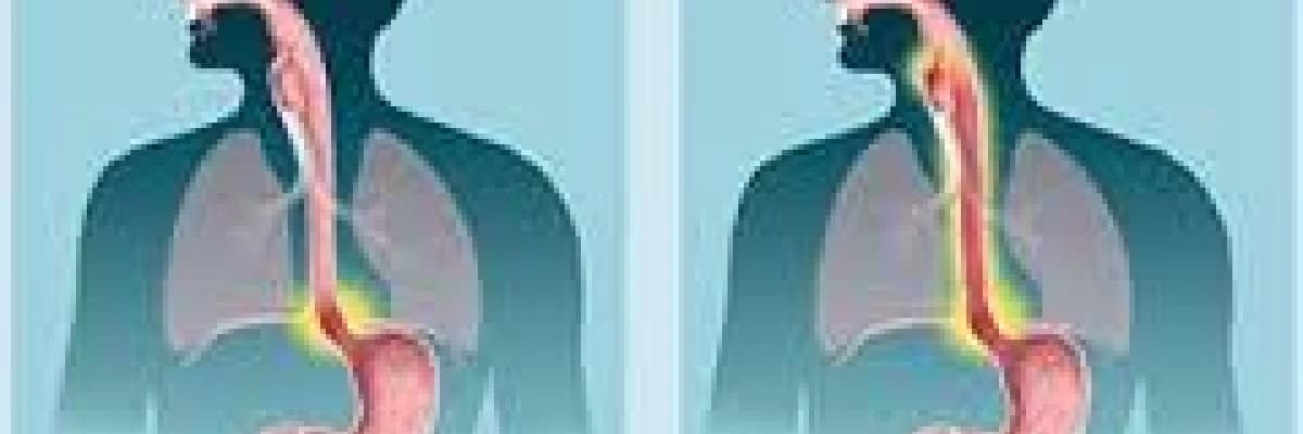 Gastroözefageal Reflu-Larengofarengeal Reflü Hastalığı- Mide Asidinin Boğaza ve Ağıza Gelmesi-Mide Asidi Regürjitasyonu