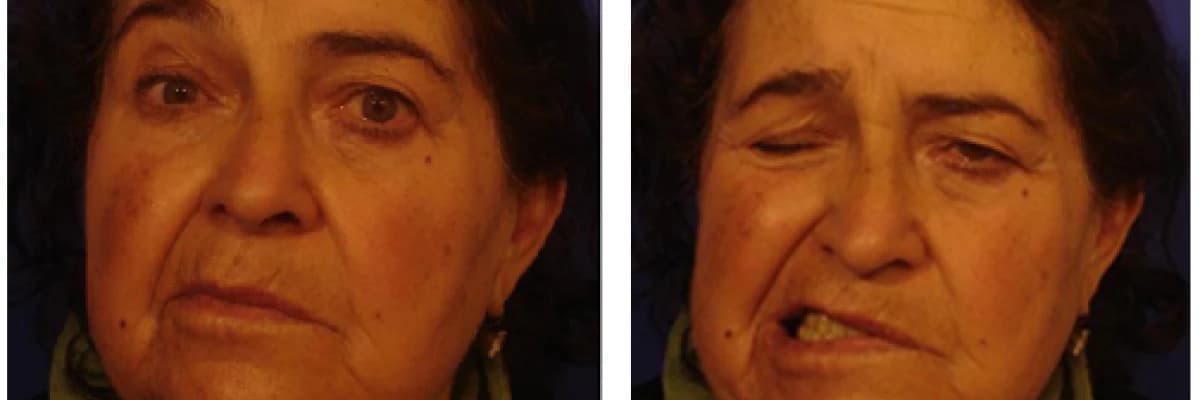 Fasyal paralizi (Yüz Felci) Nedir?