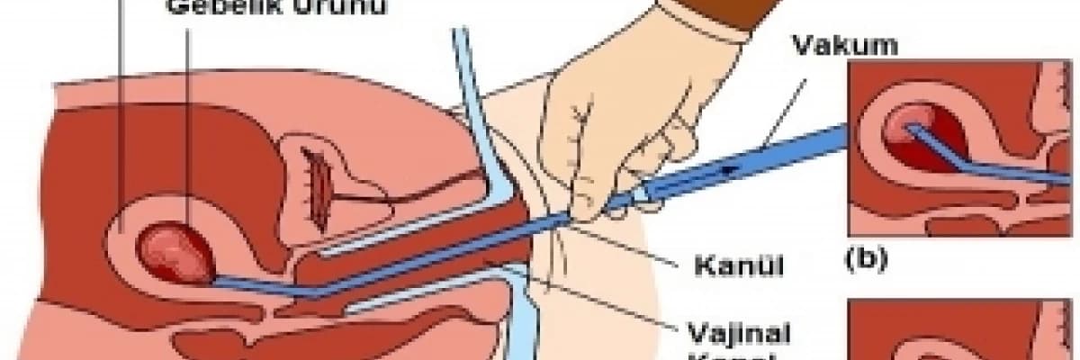 Kürtaj Nasıl Yapılır?