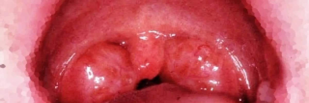 BADEMCİK VE GENİZ ETİ SORUNLARI