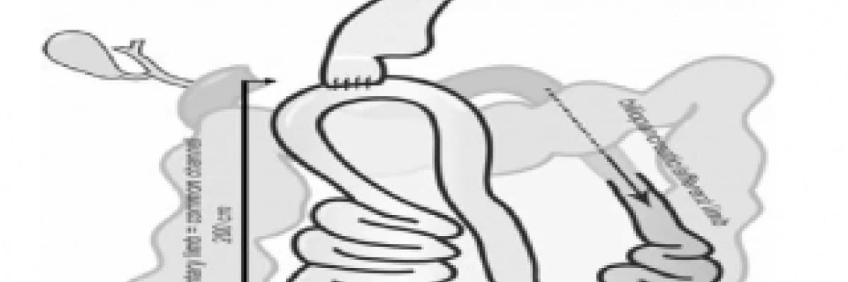 Obezite ve metabolizma cerrahisinde yeni ve umut vaadeden teknik: proksimal duodenal ileal end-to-side bypass + sleeve gastrektomi