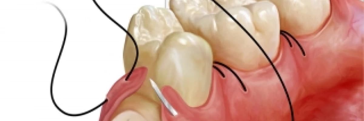 Diş çekimi sonrası dikkat edlecekler.