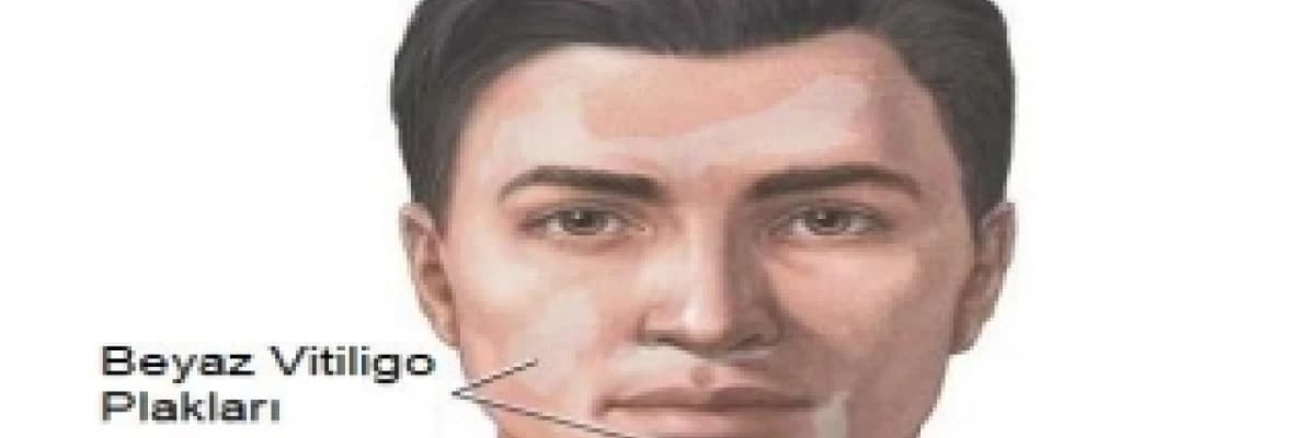 Vitiligo ( Ala Hastalığı )