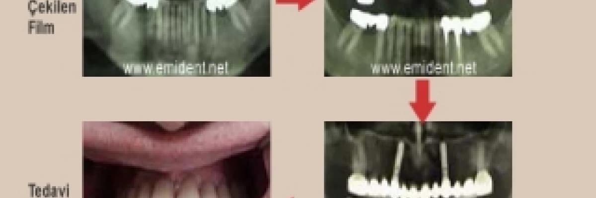 İmplant ''sorular ve cevaplar''