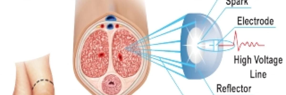 Sertleşme Probleminde Yeni Tedaviler, Düşük Yoğunluklu Şok Dalgaları ile (EDSWT)