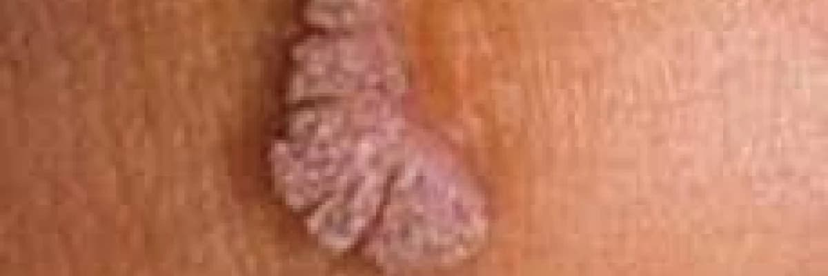 HPV,genital siğiller ve rahim ağzı kanseri