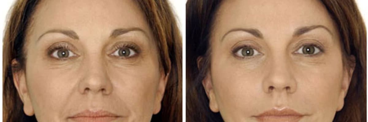 botoks nedir? Nasıl yapılır?