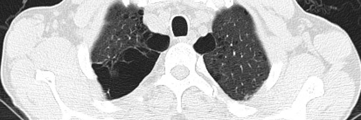 Amfizemin ameliyatsız tedavisi