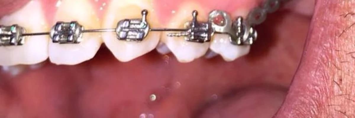 Ortodontik Tedavi Gören Hastalara Öneriler