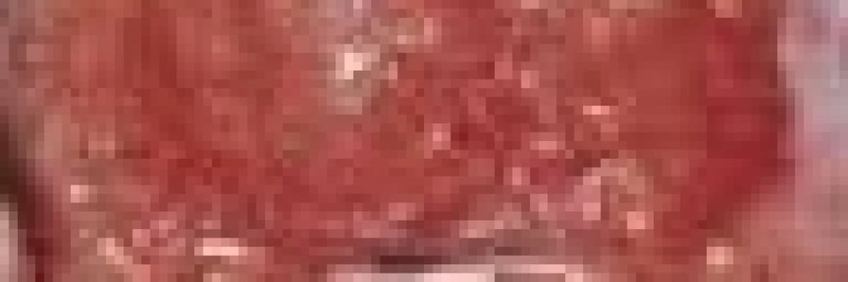 RAHİM AĞZI YARALARI VE TEDAVİSİ