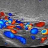 Skrotal varikosel renkli doppler ultrasonografi