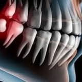 Gömülü diş nedir?